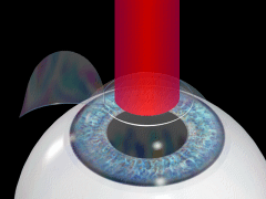 Lasik