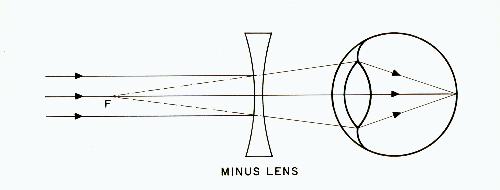 Minus lens