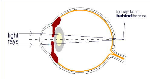 Schools And Myopia Prevention