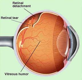 Retinal Detachment