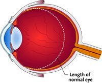 Stretched eye